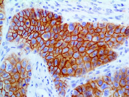 IHC of Desmoglein 3 on an FFPE Anal Carcinoma